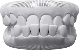 Underbite